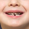 Próchnica zębów u dzieci - zapobieganie i leczenie